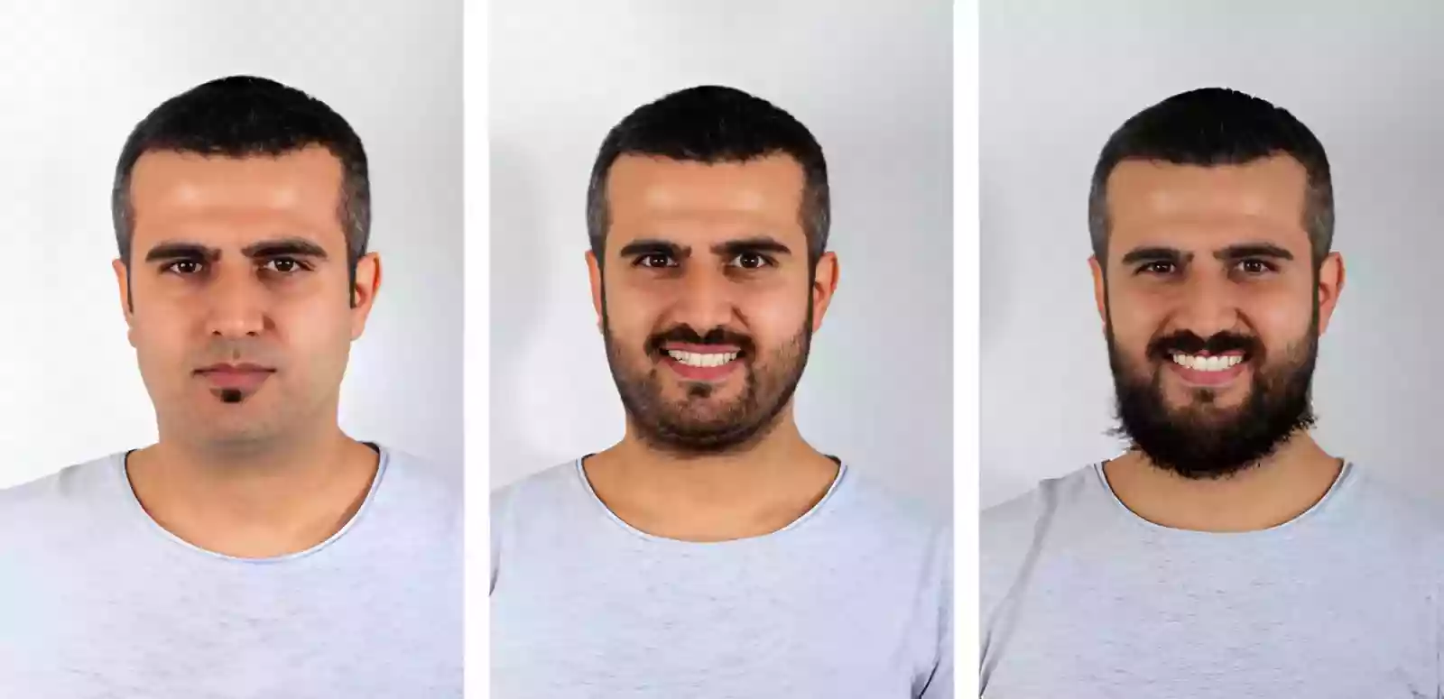 Beard Transplant Antalya
