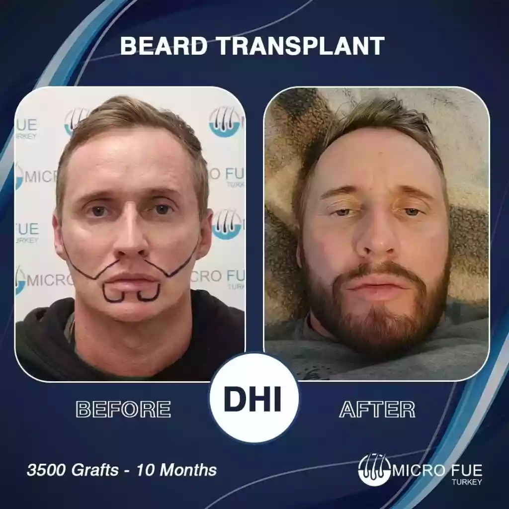 Beard Transplant Before and After Results