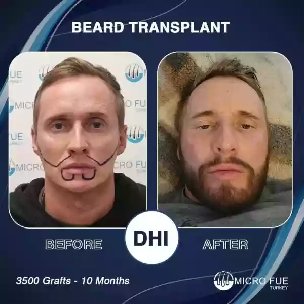 Patchy beard & scar camouflage donor hair evaluation
