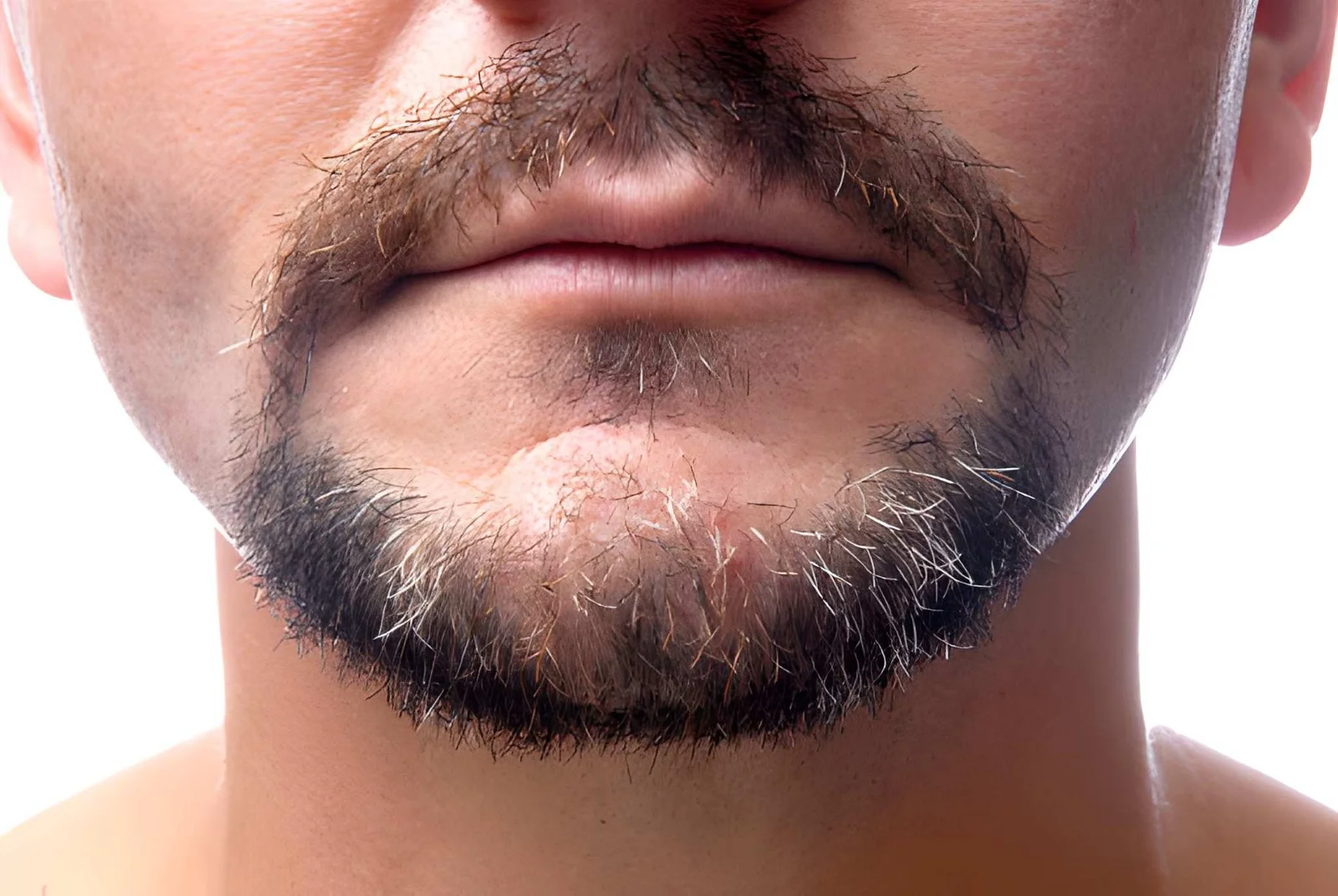 Micro grafting channel opening for patchy beard & scar camouflage