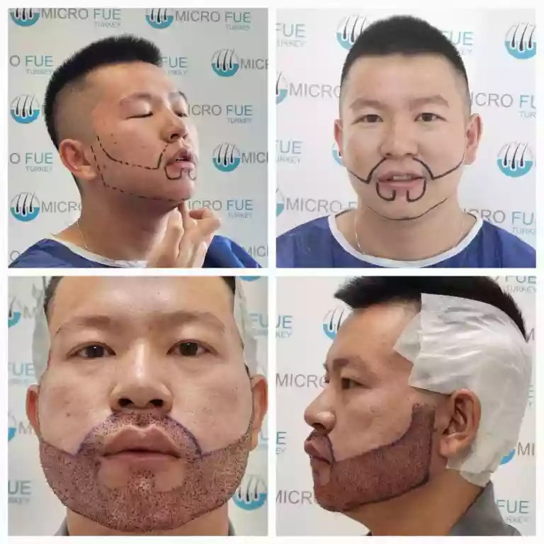 Hair transplant result example 01