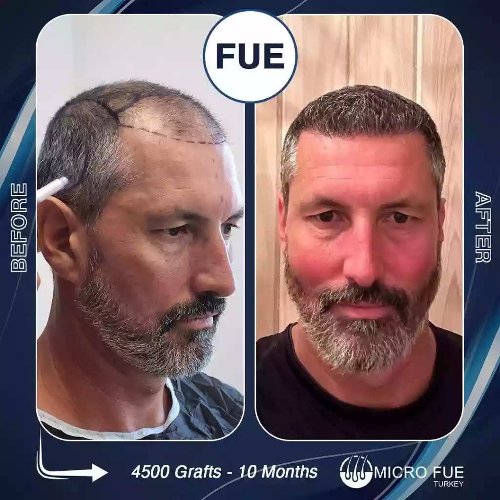 Hair transplant result example 02