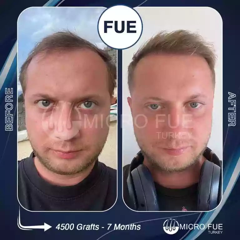 Before And After