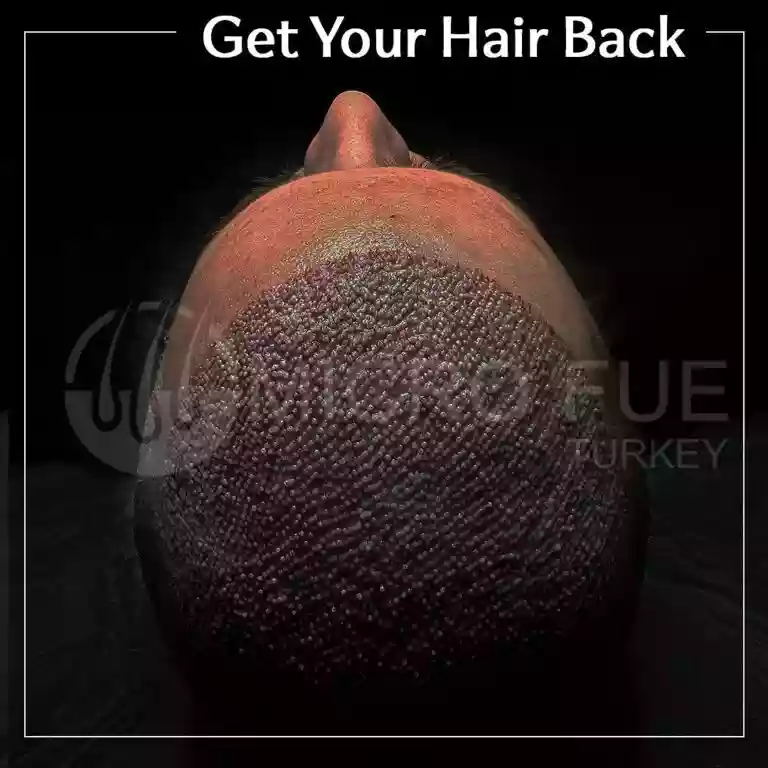 Hair transplant result example 04