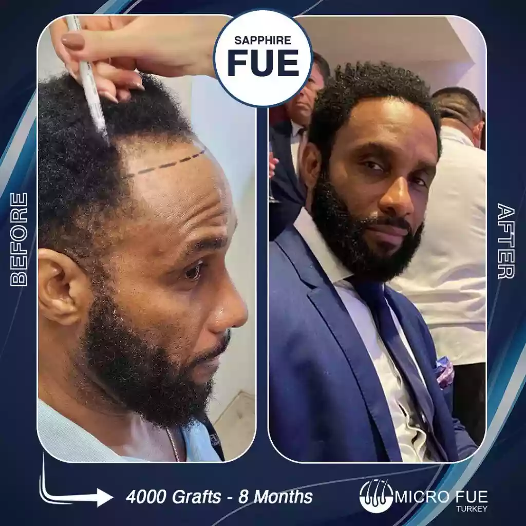 Before And After hair transplant result