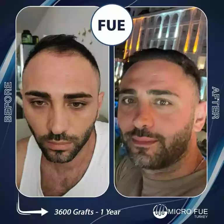 Before And After result example 06