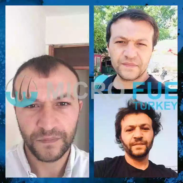 Hair transplant result example 08