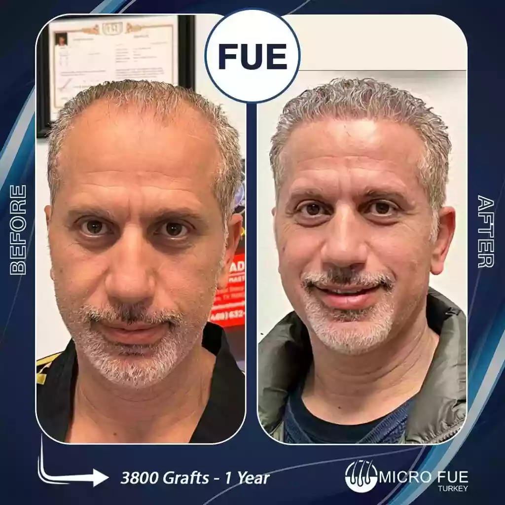 Hair transplant result example 09