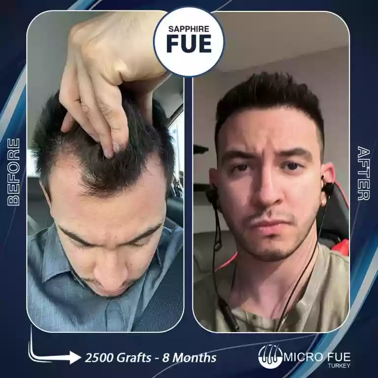 Hair transplant result example 10