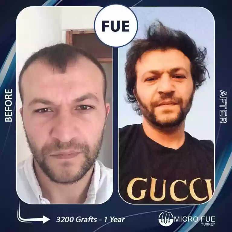 Hair transplant result example 11