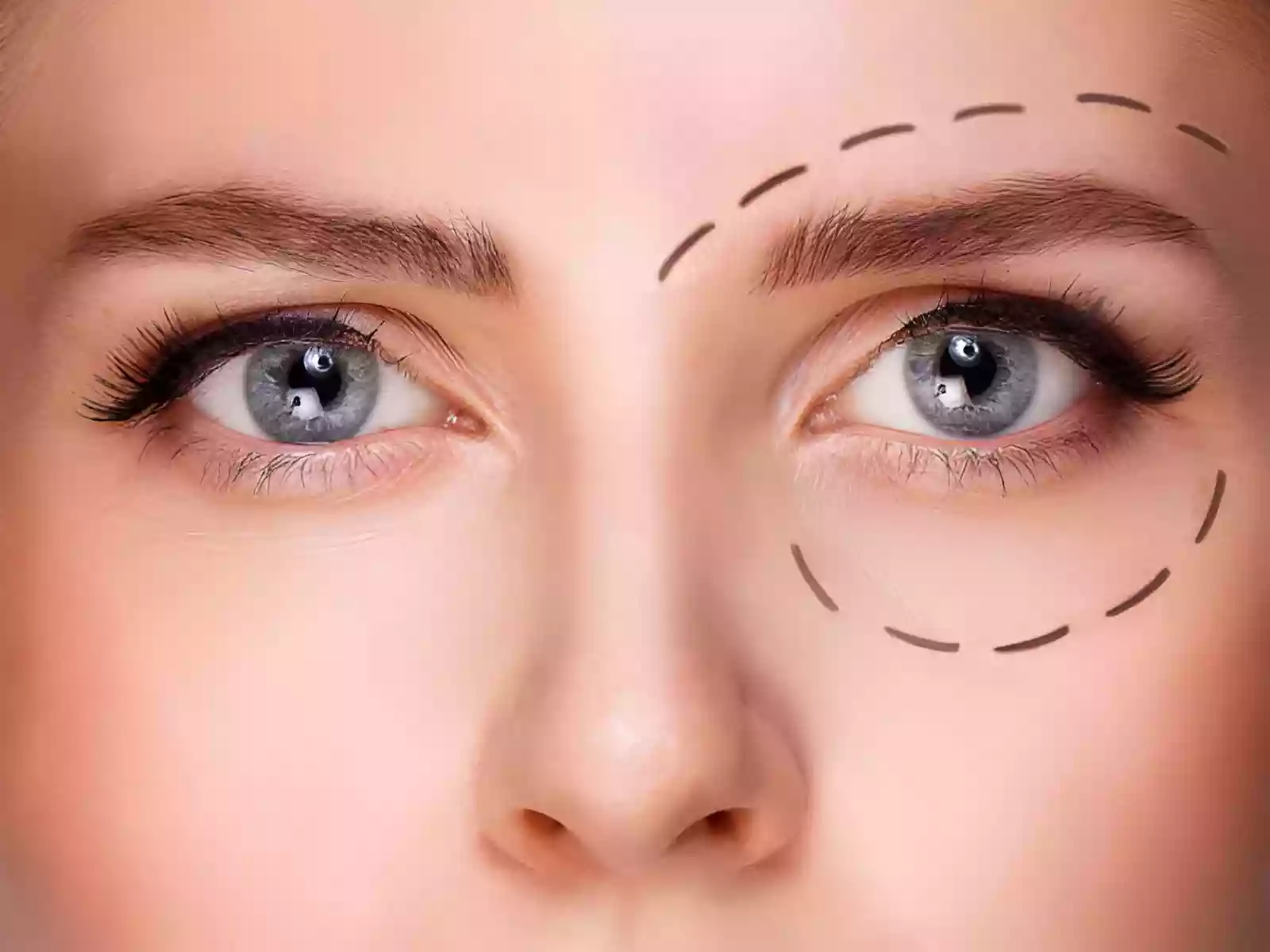 Blepharoplasty in Taksim Turkey