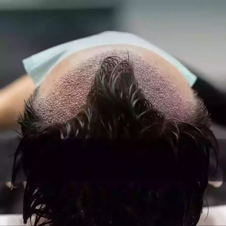 DHI Hair Transplant in Antalya graft placement