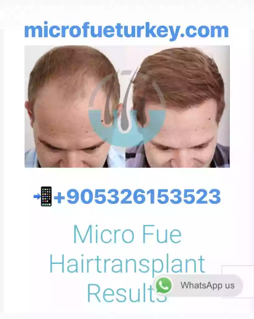 DHI Hair Transplant in Antalya implanter pen placement