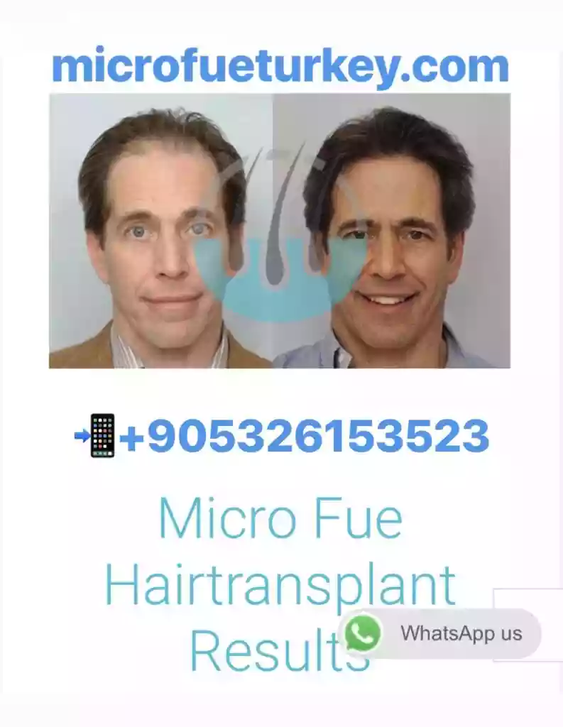 Scalp and donor assessment before DHI Hair Transplant in Antalya