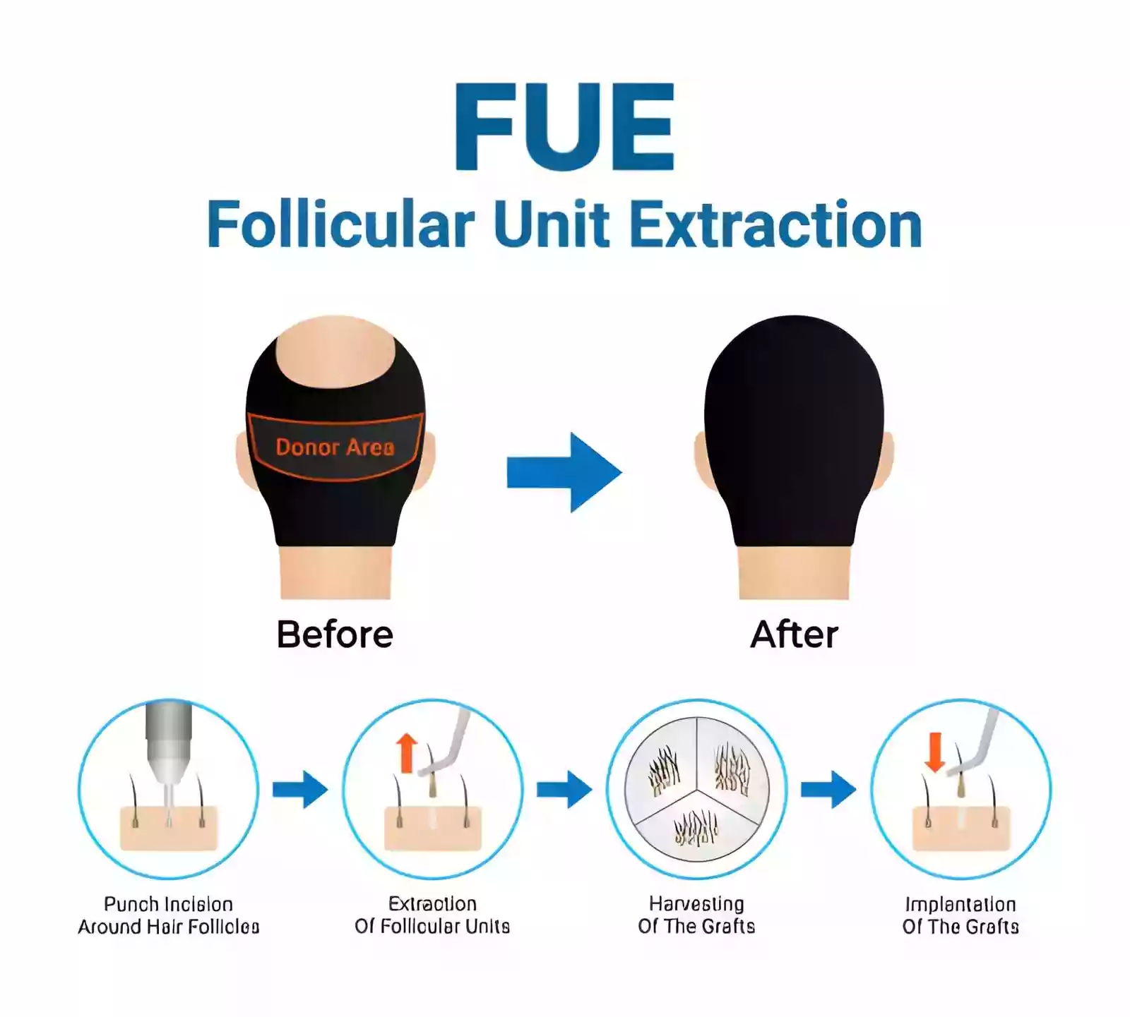 FUE Hair Transplant in Taksim