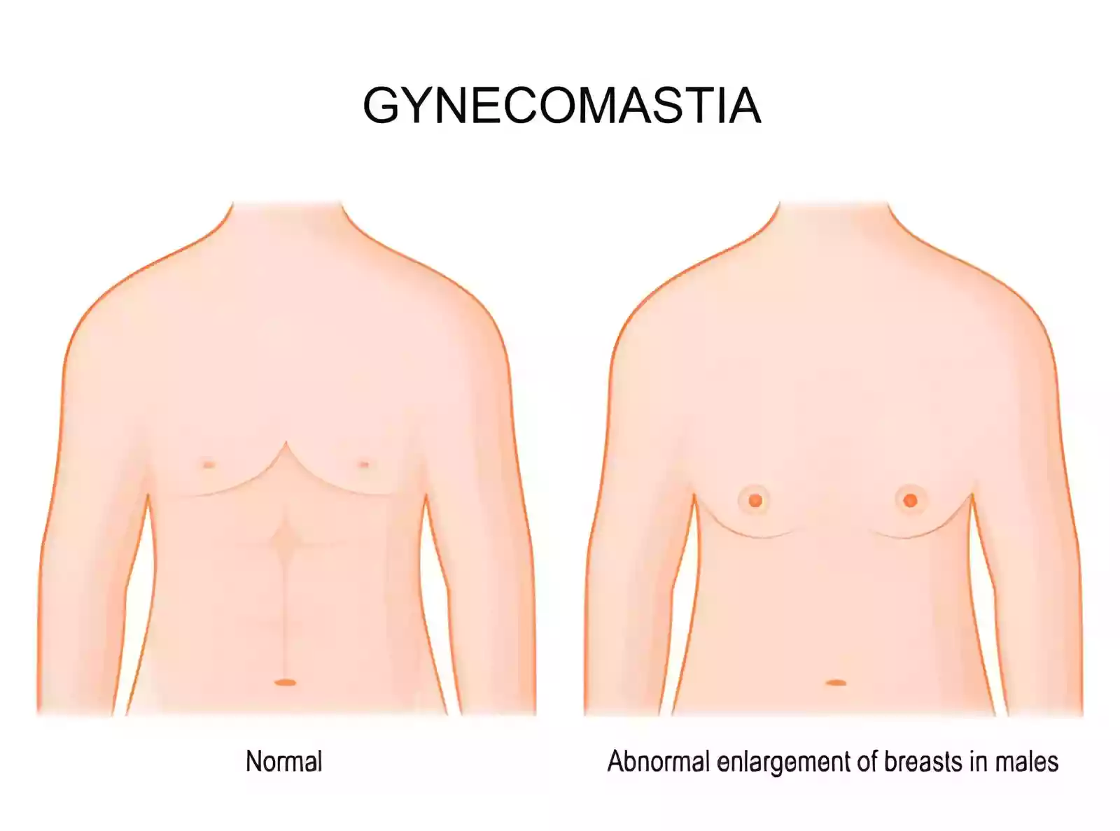Gynecomastia in Antalya