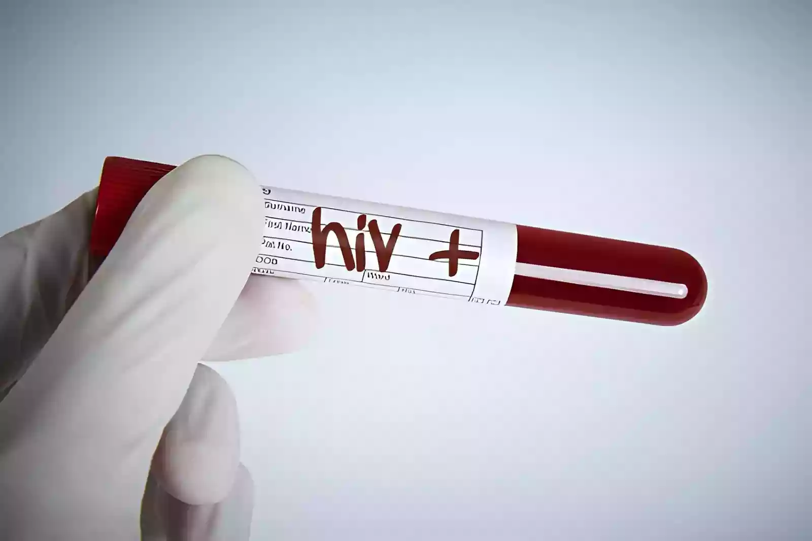 Medical review before HIV Hair Transplant Antalya Turkey