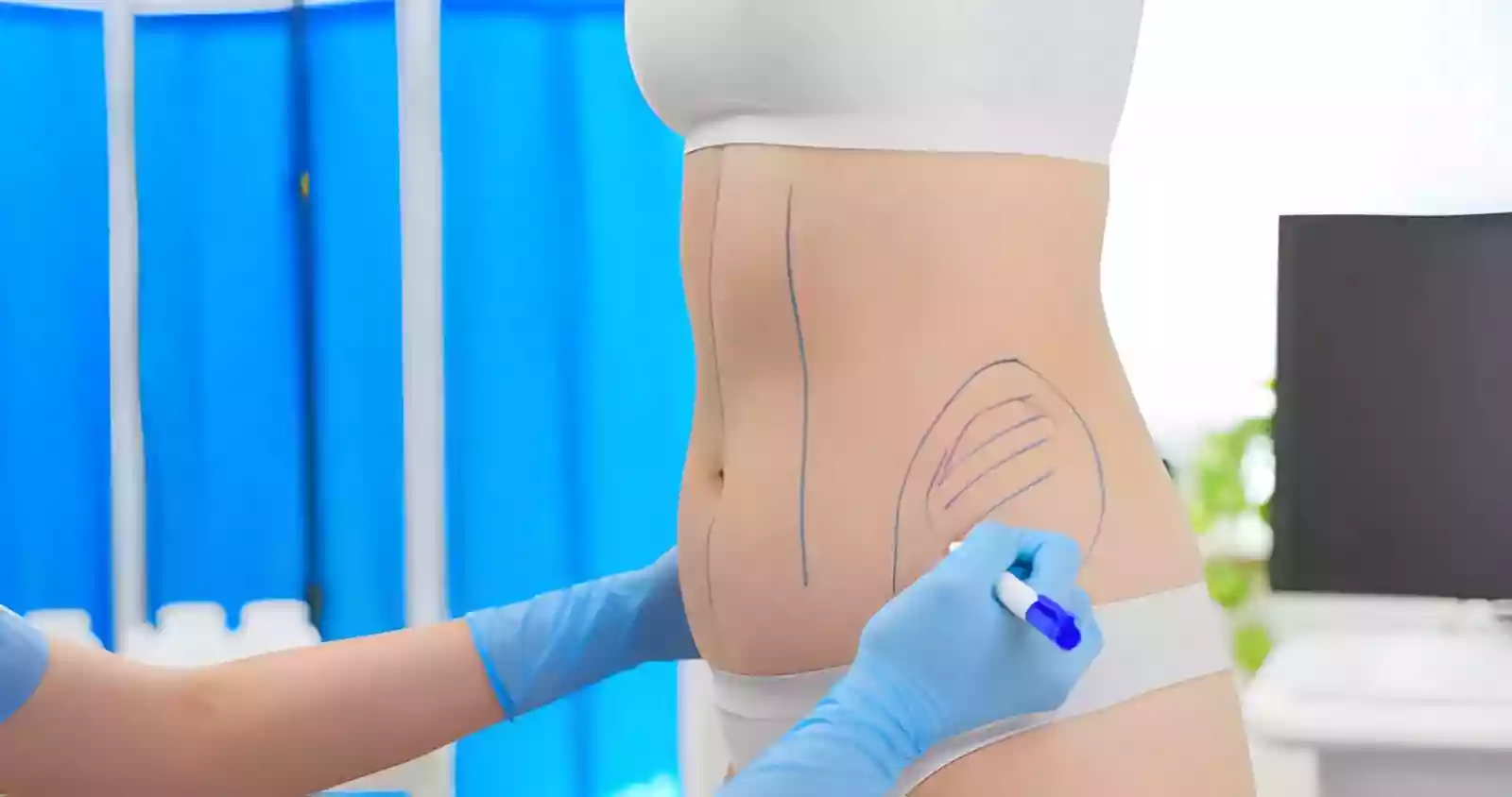 Liposuction techniques and surgical planning in Antalya