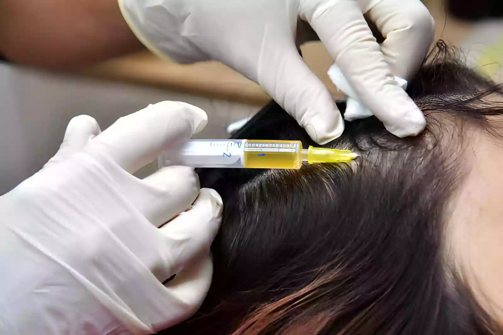 Stem Cell Hair Treatments in Antalya