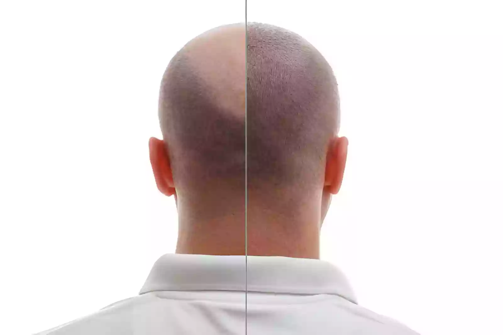 After Hair Transplant Antalya patient recovery guide