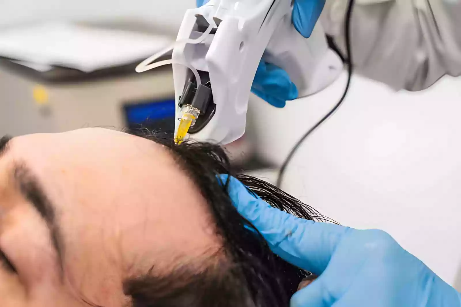 Scalp washing and graft care after hair transplant in Antalya