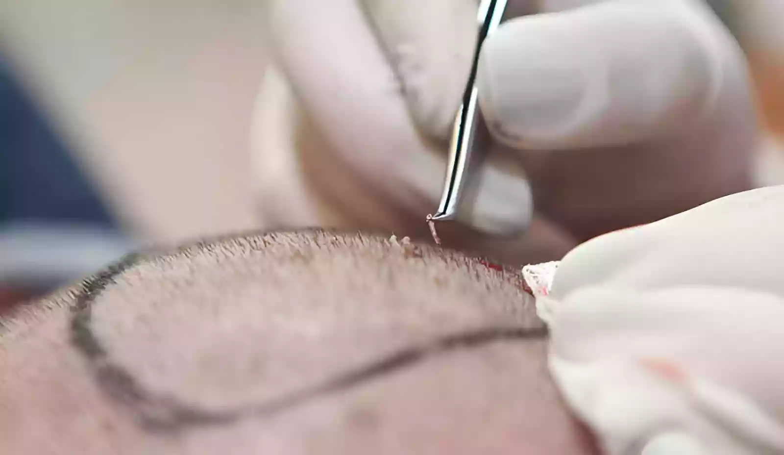 PRP Hair Treatments in Antalya consultation and scalp planning