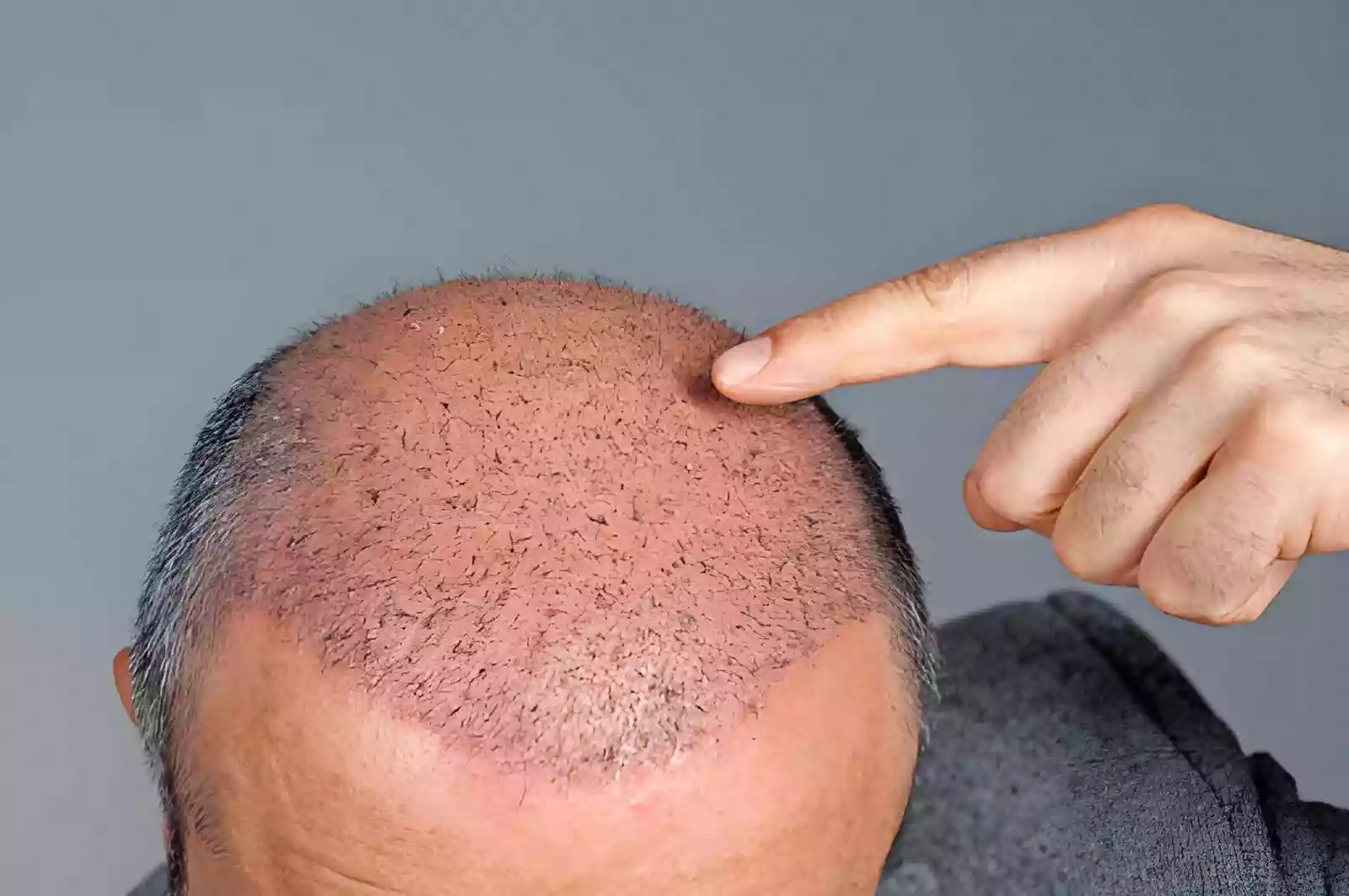 How Many Grafts Do You Need for Hair Transplant in Antalya? Treatment Zones