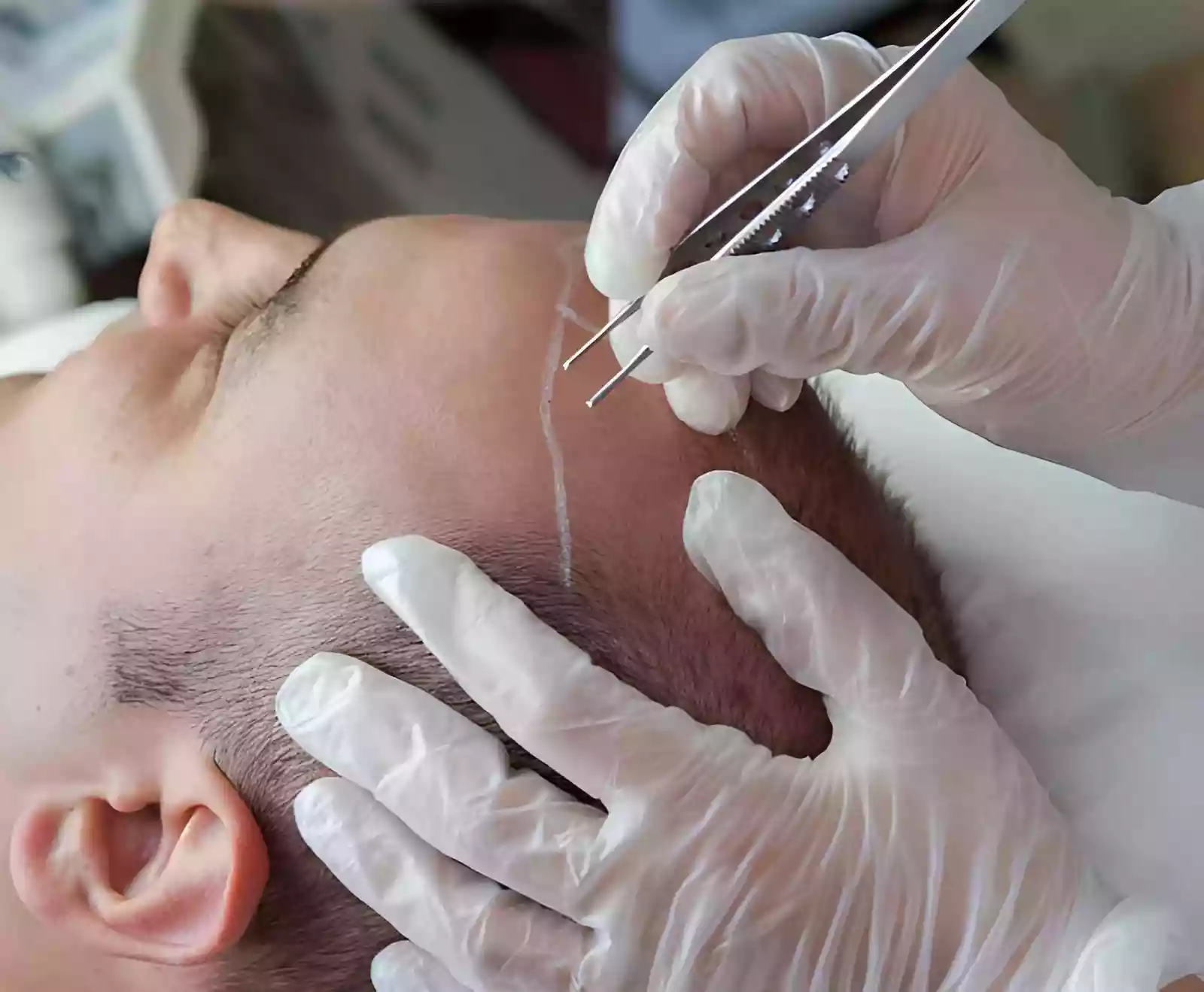 Hair Transplant Packages in Turkey