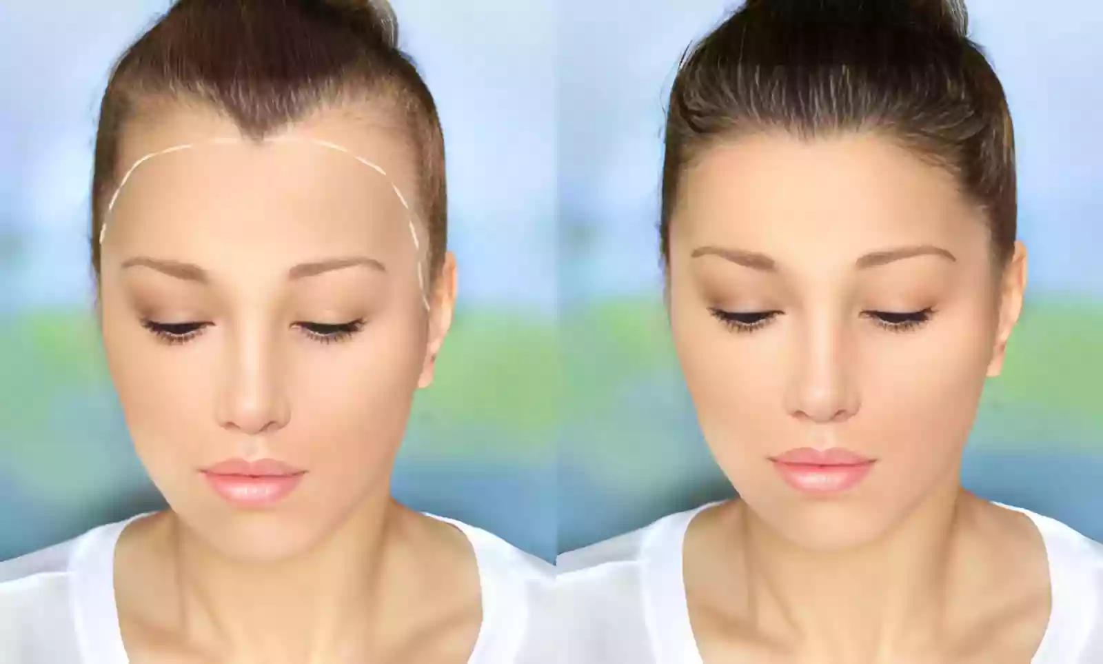 Women Hair Transplant Istanbul Turkey