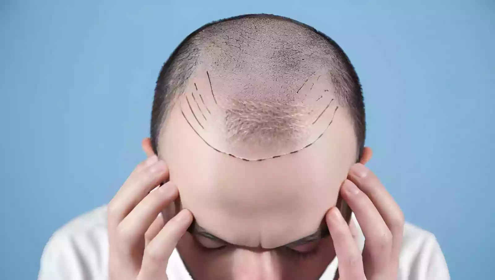 Hybrid Hair Transplant in Antalya recipient mapping