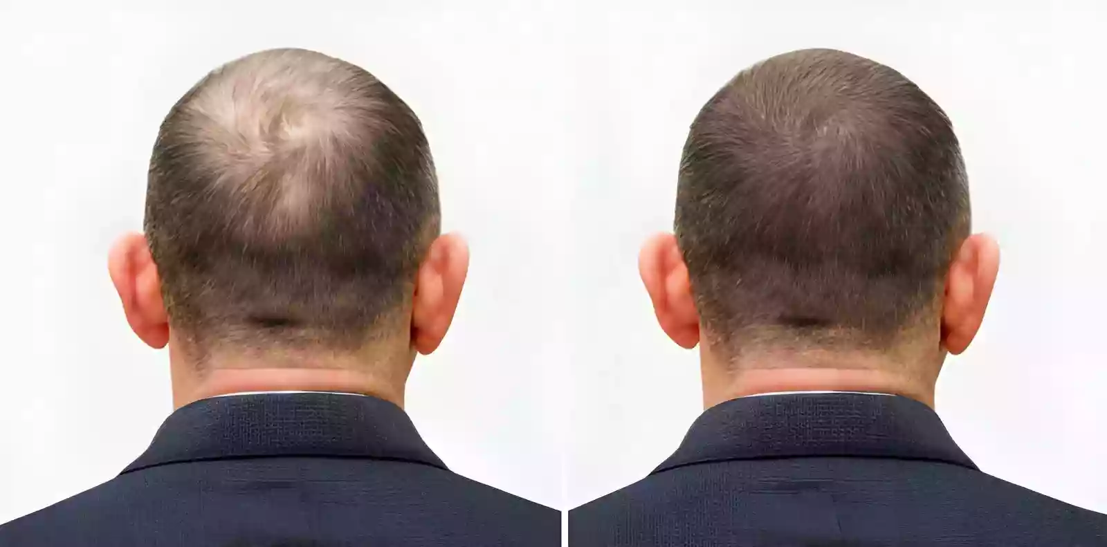Hair Transplant in Beyoglu, Istanbul