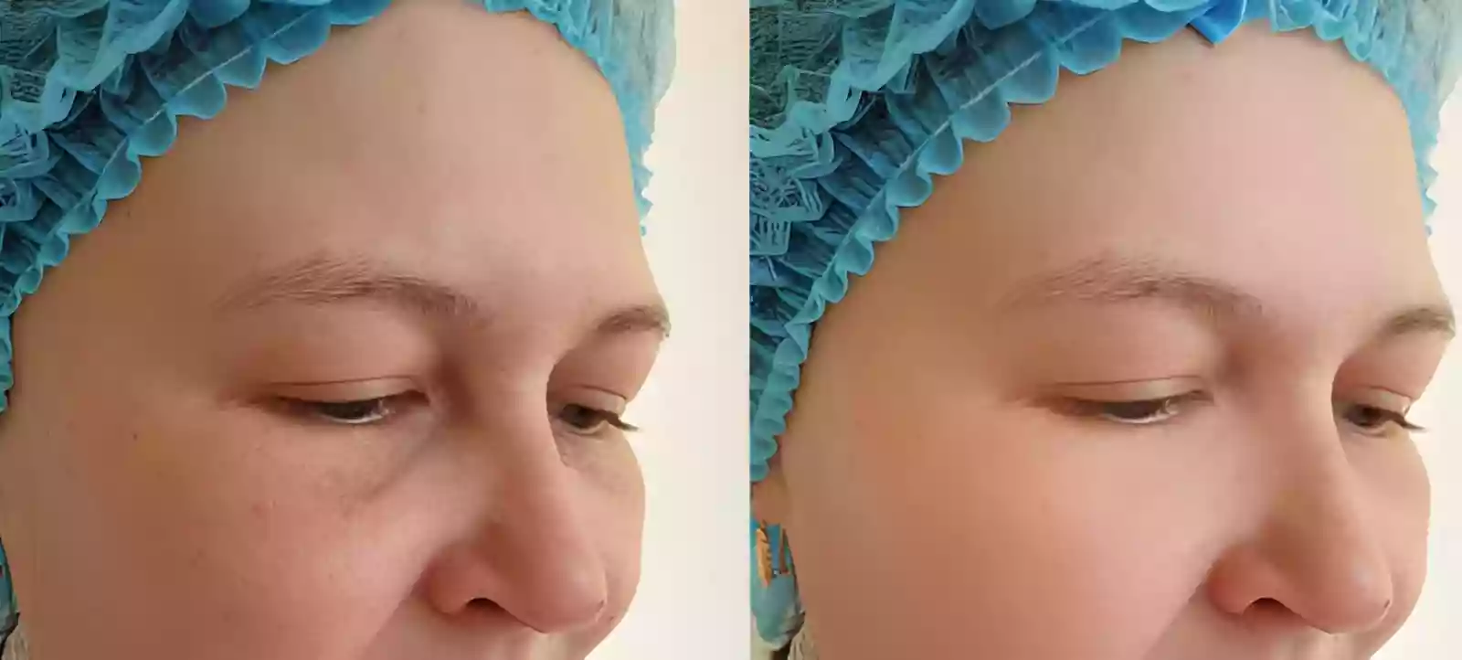 Flat 10-15 degree angle in eyebrow transplant before and after results