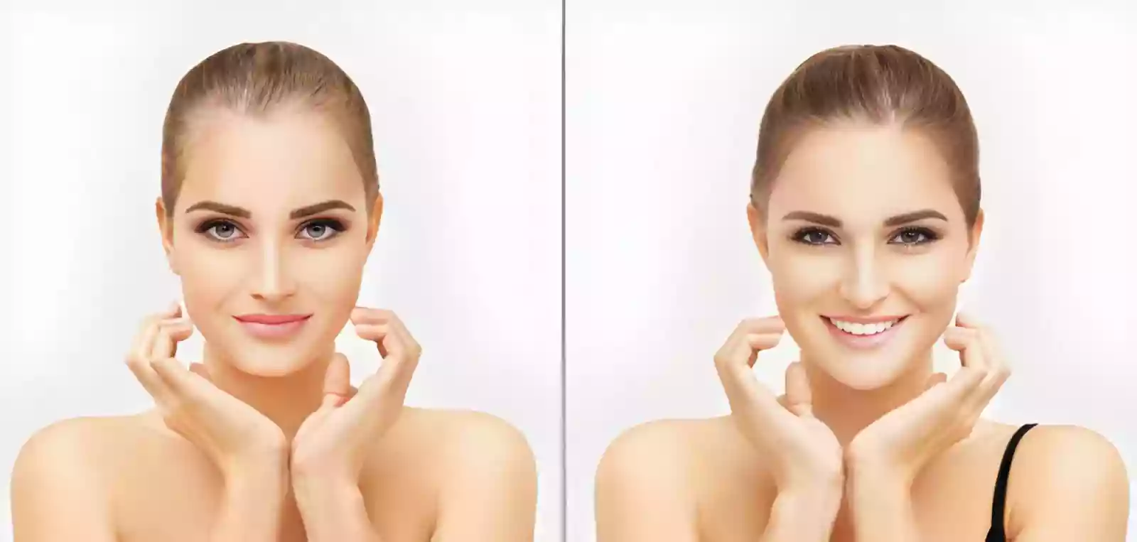 Arch and tail reconstruction in eyebrow transplant before and after results