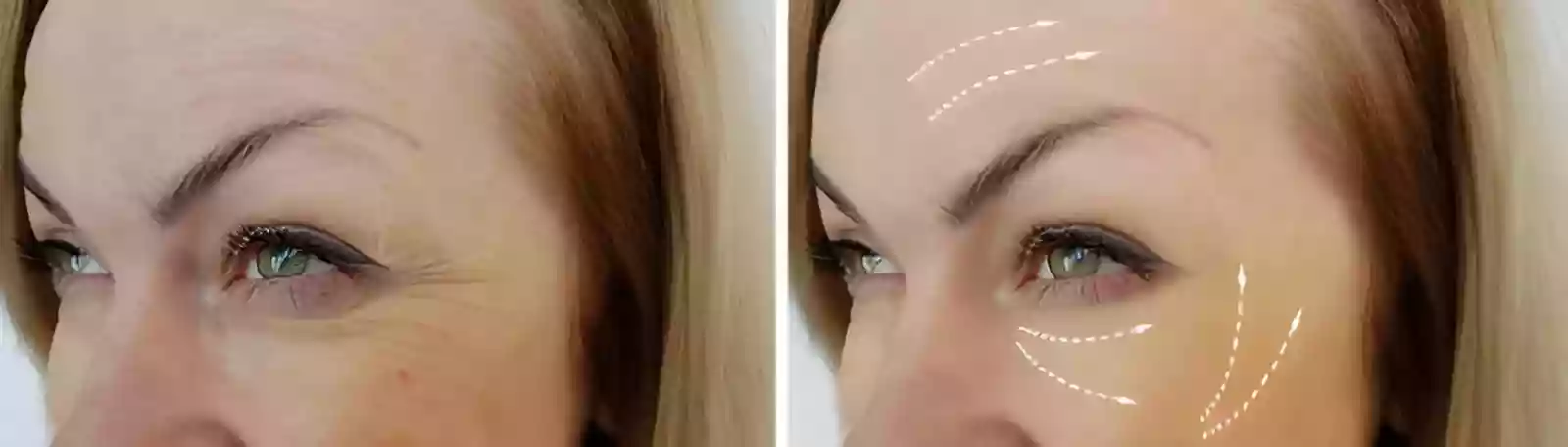 DHI Choi needle precision in eyebrow transplant before and after results