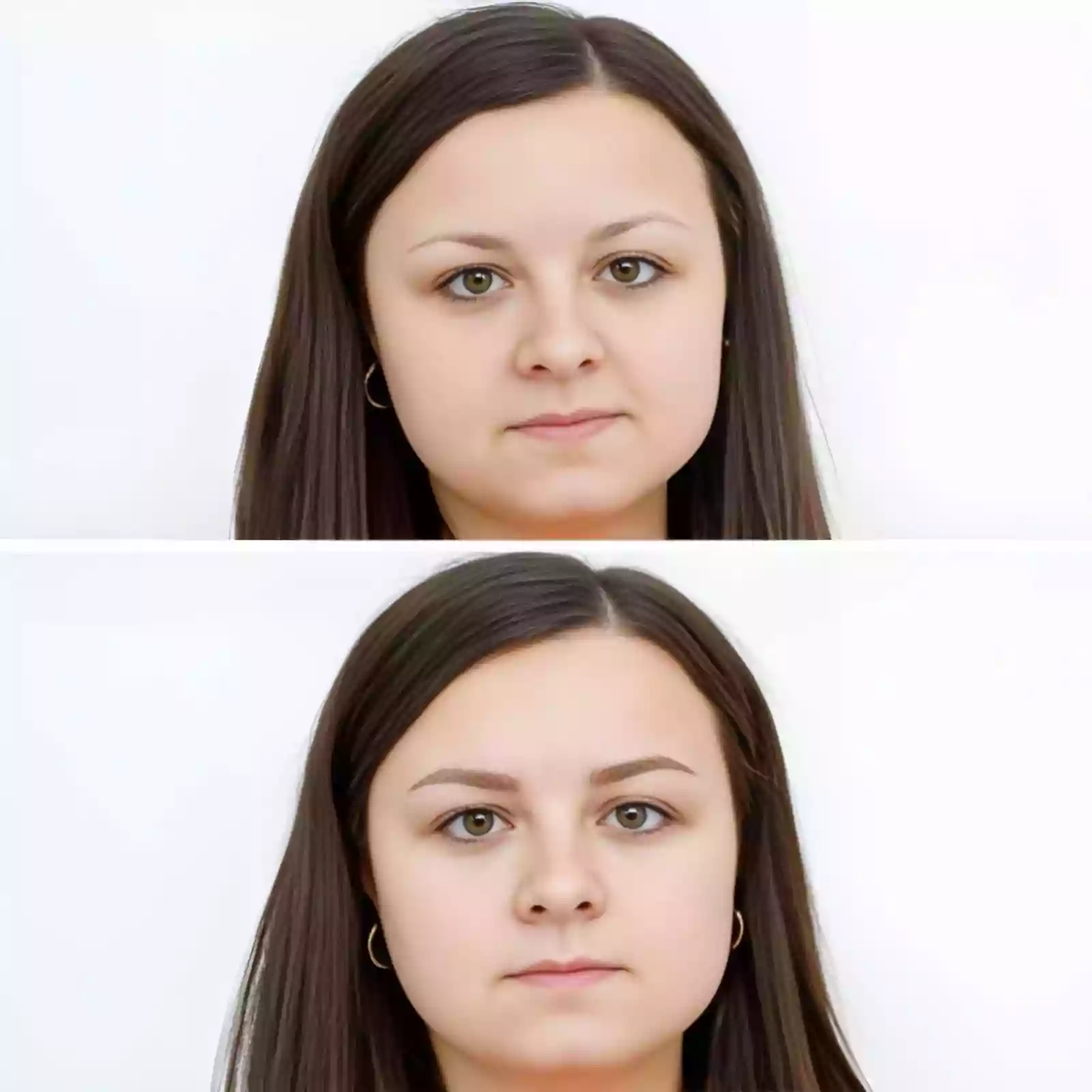 Single hair follicle sorting in eyebrow transplant before and after results