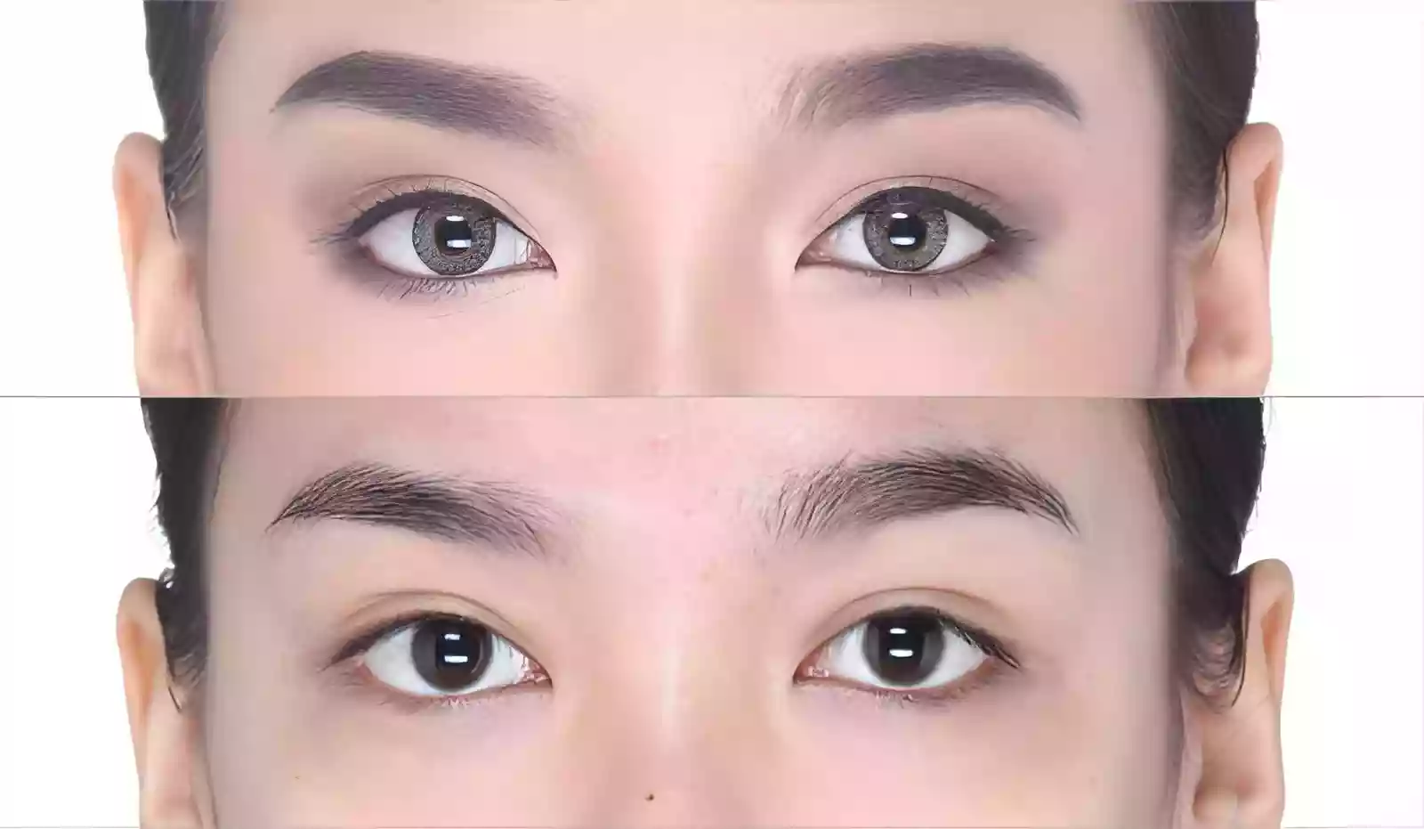 Microscopic single hair insertion in eyebrow transplant before and after results